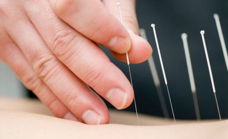 Lee más sobre el artículo Acupuntura: equilibrio y salud a través de la energía